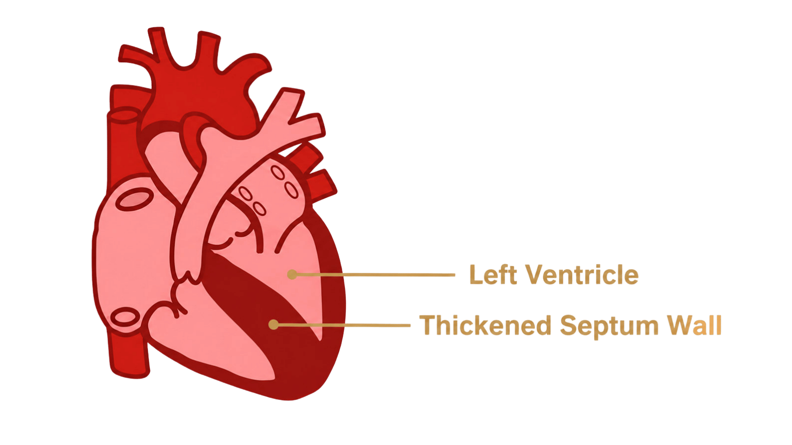 hcm left ventricle and thickened septum wall hcm left ventricle and thickened septum wall